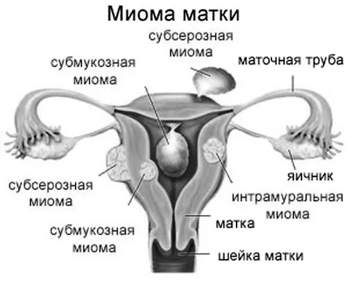 матки