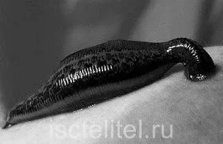 П'явки при артрозі як лікувати суглоби п'явками