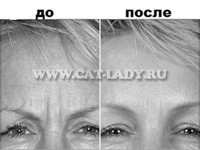 парафінотерапія