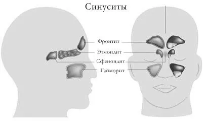 Гострий синусит, симптоми і лікування захворювання лікування