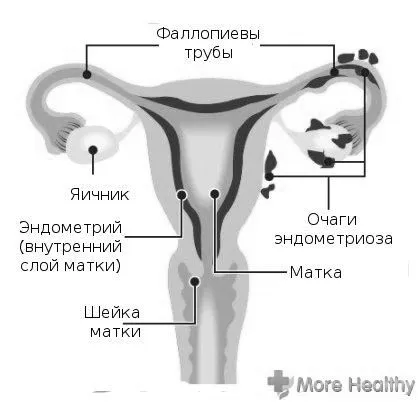 Відгуки про дюфастона при ендометріозі відгуки