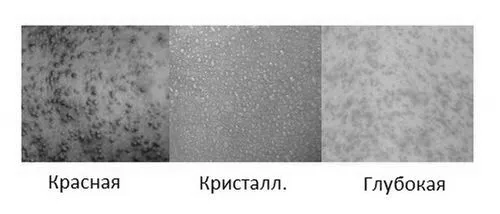 як лікувати пітницю на шиї у дитини