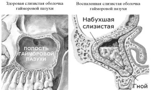гострий