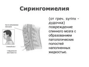 сирингомієлія