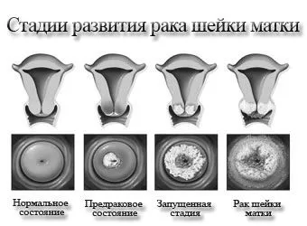 шийки