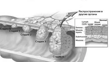 захворювання