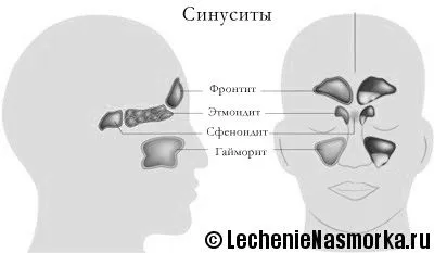 як лікувати тривалий синусит