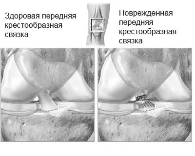 як лікувати розтягнення хрестоподібних зв'язок