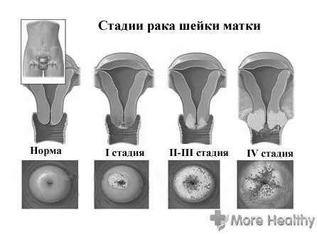 Рак 3 ступеня актуальні