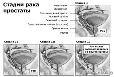 Рак 3 ступеня ступеня