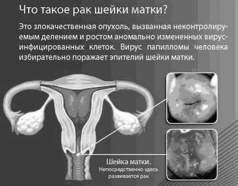 матки