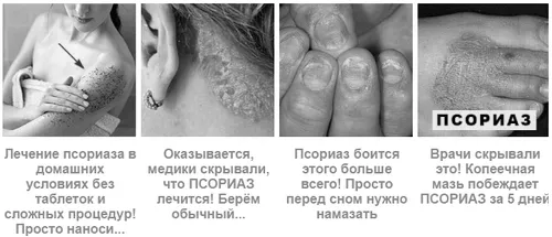 псоріаз нігтів