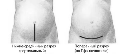 черевної