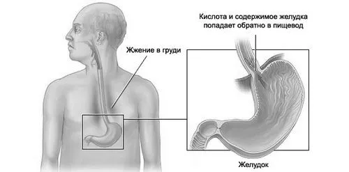 як лікувати печію травами