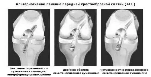 колінного