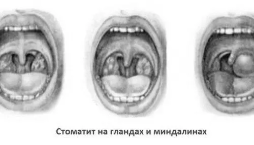 Стоматит на гландах гландах