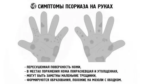 Псоріаз на руках: причини, симптоми, діагностика, лікування причини