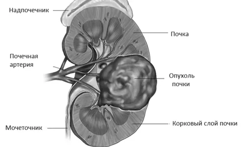 Рак нирки: скільки живуть після операції, прогнози скільки