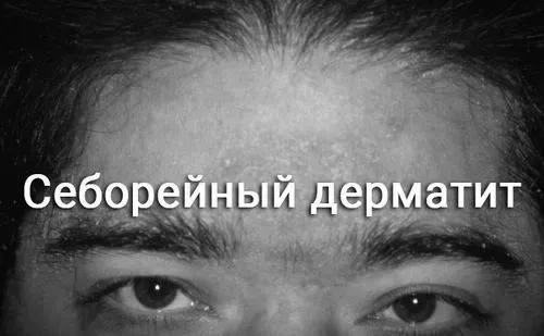 дерматит