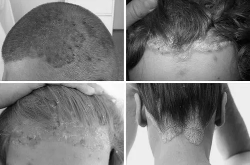 псоріаз