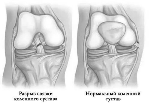 язок