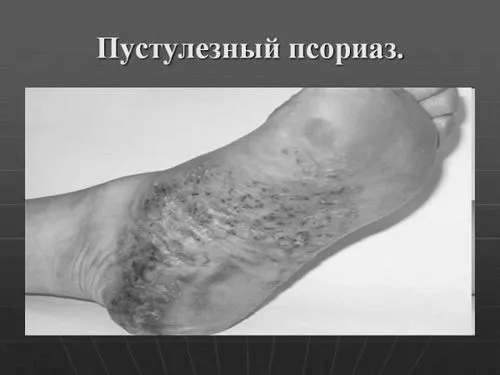 псоріаз