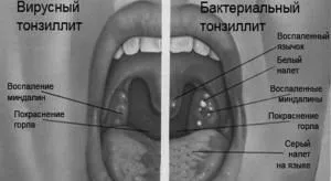 Видалення мигдалин при хронічному тонзиліті: відгуки та наслідки наслідки