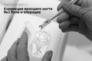 Вріс ніготь на нозі ніготь