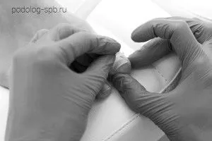 Вріс ніготь на нозі як вилікувати врослий ніготь без операції