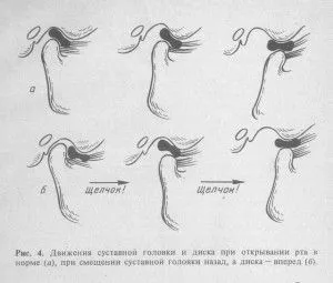 як лікувати розтягнення щелепи