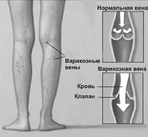 варикоз