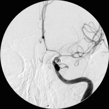 як і чим лікувати судини