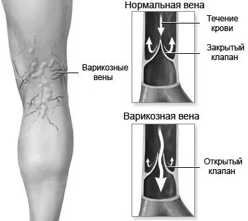методи лікування варикозу ніг