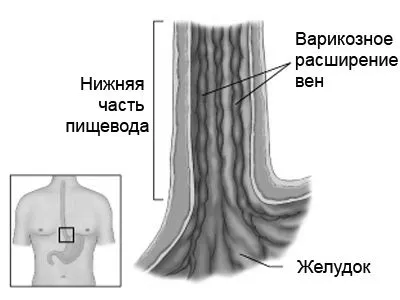 варикоз