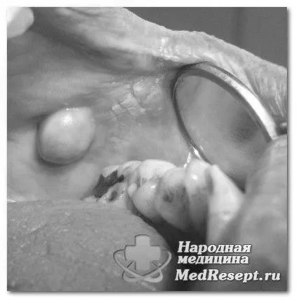 лікування свища