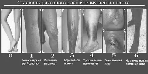 ногах