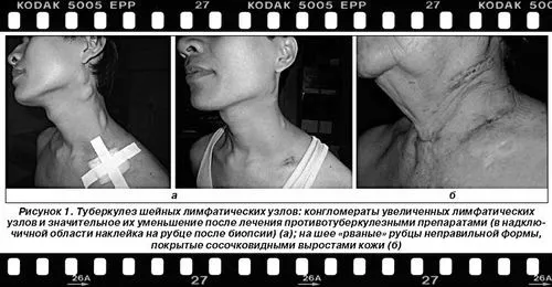 лімфатичних