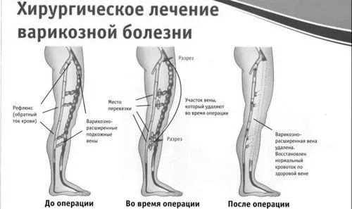 варикоз вен на ногах симптоми
