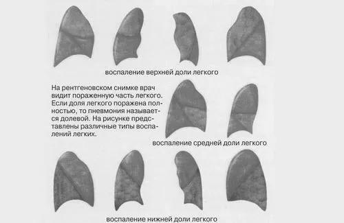 запалення