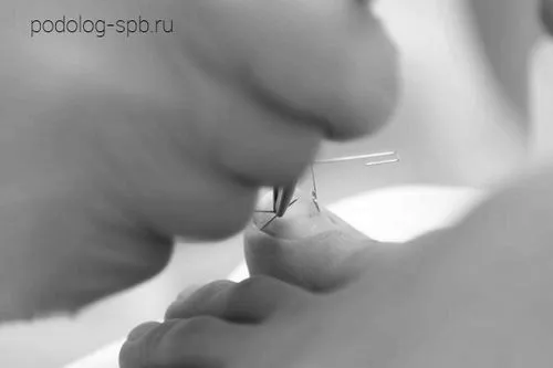 Вріс ніготь на нозі ніготь