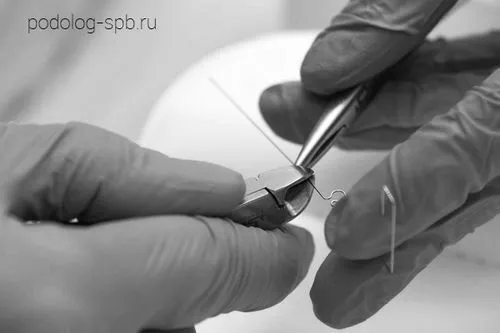 Вріс ніготь на нозі ніготь