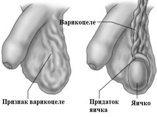 варикоцеле вагітність після операція безпліддя чоловік зачаття