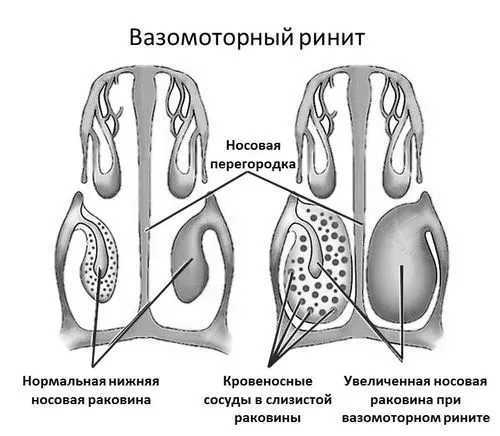 риніт