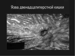 симптоми