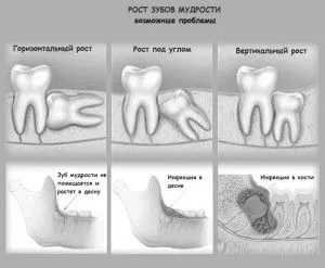 чи потрібно видаляти зуби мудрості