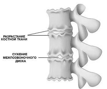 остеохондроз
