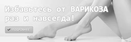 як лікувати сильний варикоз