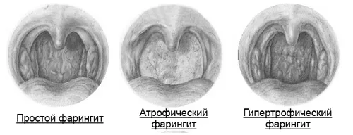 хронічний фарингіт нежить