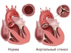 stenoza aortica, simptome, cauze, tratamente curente