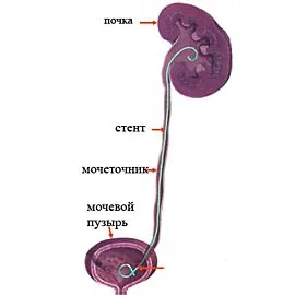 A sztent húgyvezeték, aki lekerült a húgyvezeték stent után stent behelyezés vese fáj